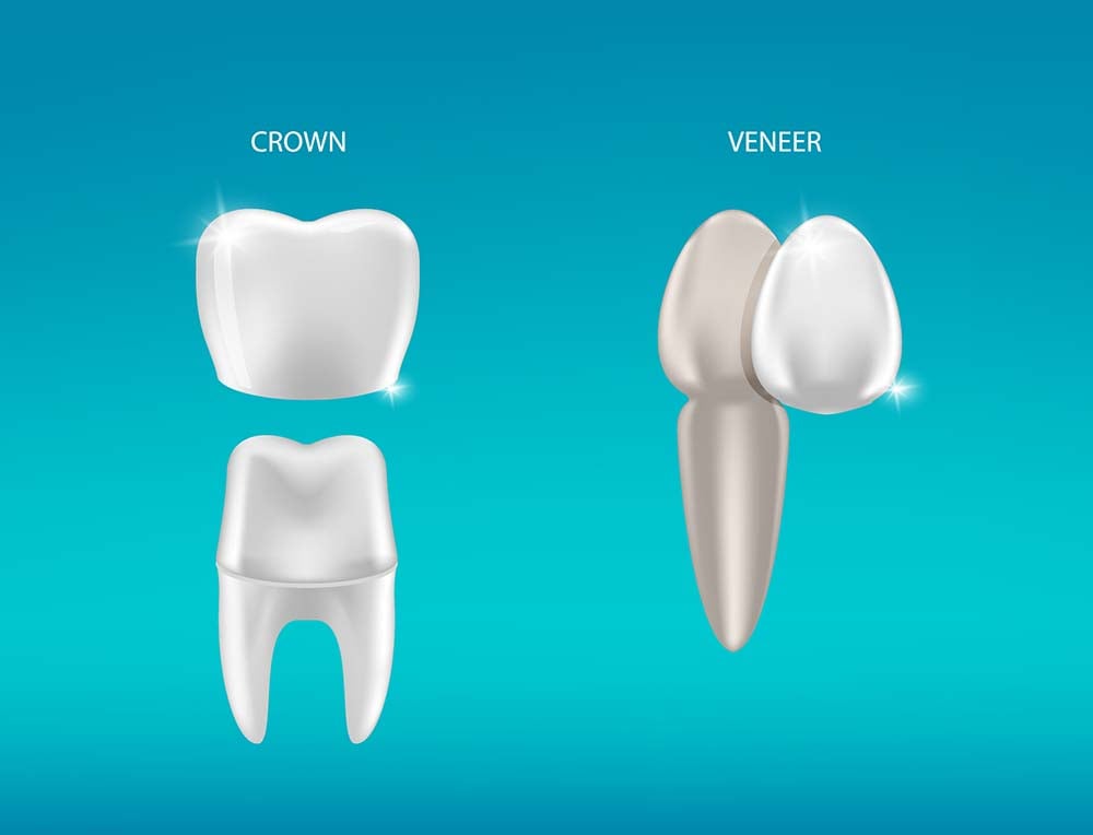 Veneers vs Crowns Knowing the Pros and Cons